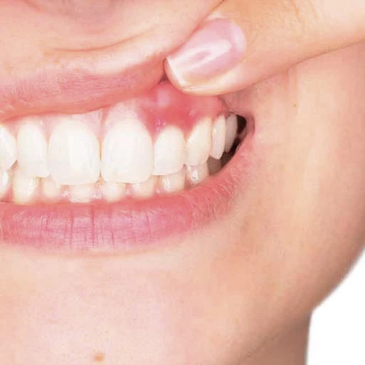 Irritación de la encía por blanqueamiento dental